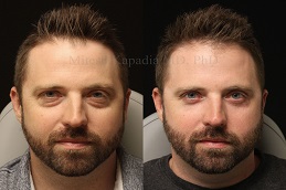 Eyelid Surgery Before & After clinic Islamabad.