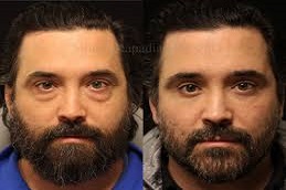 Eyelid Surgery Before & After clinic Islamabad,