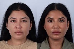 Eyelid Surgery Before & After clinic Islamabad