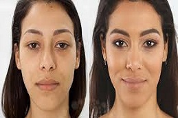 Eyelid Surgery Before & After clinic