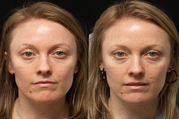 Eyelid Surgery Before & After in Islamabad