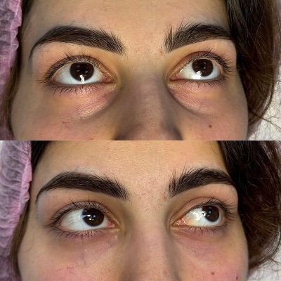Eyelid Surgery in Islamabad Pakistan