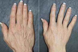 Fat Grafting Before & After Islamabad.
