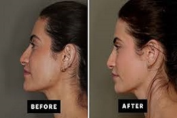 Fat Grafting Before & After Islamabad,