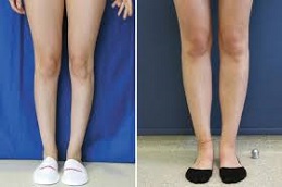 Fat Grafting Before & After clinic Islamabad,
