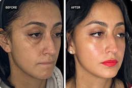 Fat Grafting Before & After clinic Islamabad