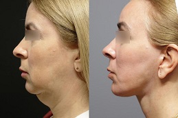 Fat Grafting Before & After clinic in Islamabad,