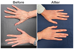 Fat Grafting Before & After,