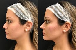 Filler Dissolving Injections Before and After in islamabad