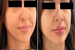 Filler Dissolving Injections Before and After islamabad,