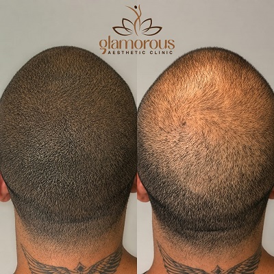 Hair Transplant Cost in Islamabad Pakistan