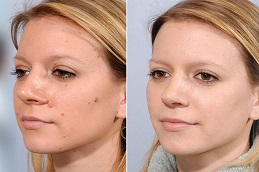 Mole Removal Treatment Before and After