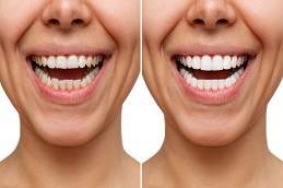 Results OF Dentistry in Islamabad Pakistan