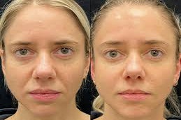 Results OF Filler Dissolving Injections Islamabad