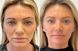 Results OF Filler Dissolving Injections clinic Islamabad Pakisan