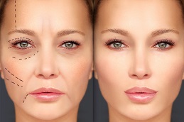 Results OF Filler Dissolving Injections in Islamabad