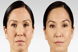 Results OF Filler Dissolving Injections in pakistan,