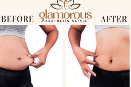 Results OF Mounjaro Injection clinic Islamabad