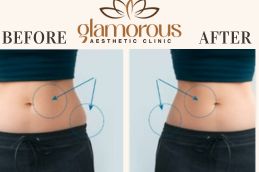 Results OF Mounjaro Injection in Islamabad