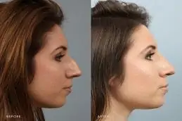 Results OF Nose Tip Plasty clinic in Islamabad