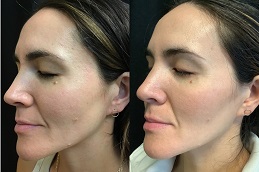 Results OF Pico Laser Treatment for Dark Lips in Islamabad