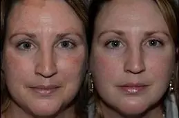 Results OF Pico Laser Treatment in islamabad