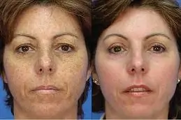 Results OF Pico Laser Treatment in islamabad,