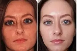 Results OF Pico Laser Treatment