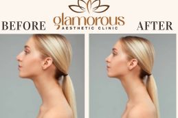 Results OF Rhinoplasty Clinic Islamabad