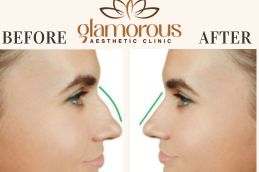 Results OF Rhinoplasty Islamabad