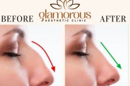 Results OF Rhinoplasty Islamabad Pakistan