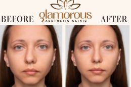 Results OF Rhinoplasty Islamabad,