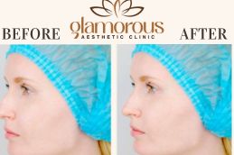 Results OF Rhinoplasty clinic in Islamabad
