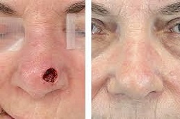 Skin Biopsy before & after,