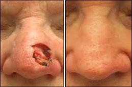 Skin Biopsy before & after clinic in islamabadv
