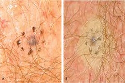 Skin Biopsy before & after islamabad pakisan
