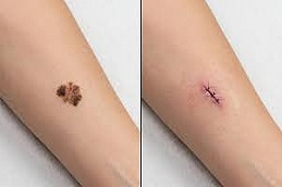 Skin Biopsy before & after islamabad