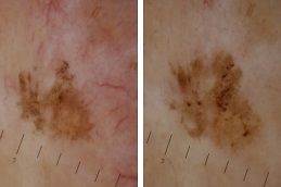 Skin Biopsy before & after pakistan