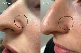 Skin Biopsy before & after