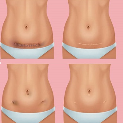 Surgical Scar Revision in Islamabad