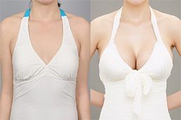 Breast Fillers Before and After Islamabad