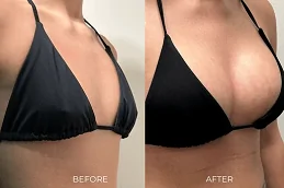 Breast Fillers Before and After in Pakistan