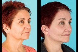 Cheek Augmentation Before and After Pakistan