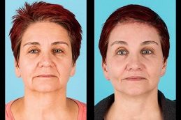 Cheek Augmentation Before and After clinic islamabad Pakistan