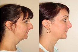 Cheek Augmentation Before and After islamabad Pakistan