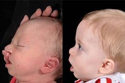 Cleft Lip And Palate Surgery Before & After Islamabad Pakistan ,
