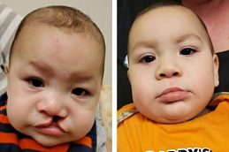 Cleft Lip And Palate Surgery Before & After Islamabad Pakistan