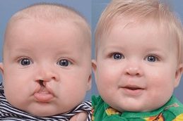 Cleft Lip And Palate Surgery Before & After Pakistan