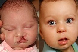 Cleft Lip And Palate Surgery Before & After clinic islamabad