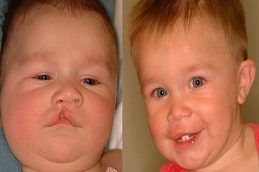 Cleft Lip And Palate Surgery Before & After islamabad